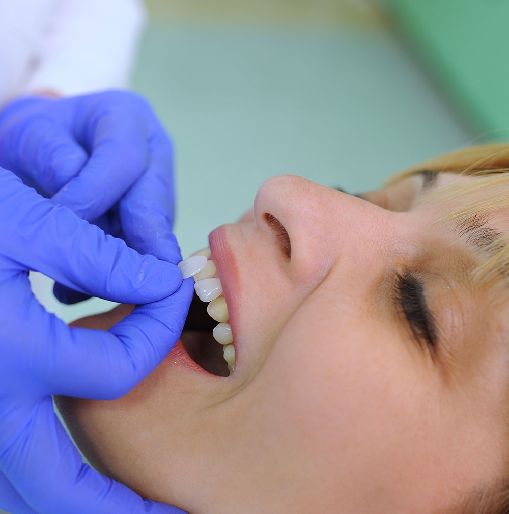woman receiving dental veneers to obtain whiter teeth