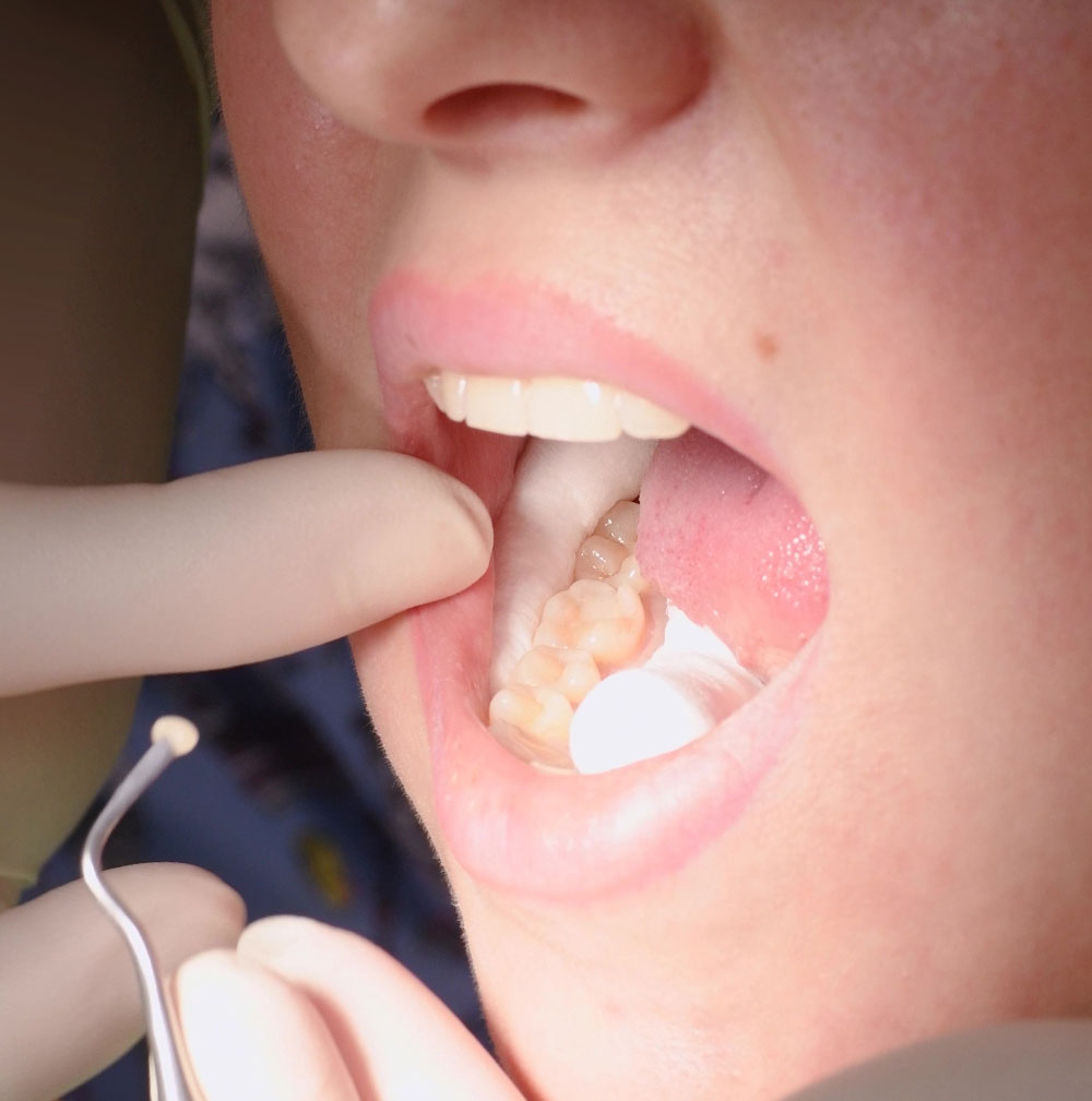 close up of woman getting a tooth filled