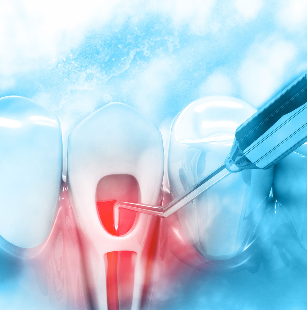 illustration of the root canal process